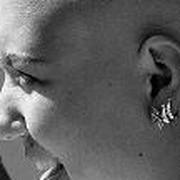 Un autotrasplante de células madre de cordón umbilical sana a una niña de seis años con leucemia linfoblástica